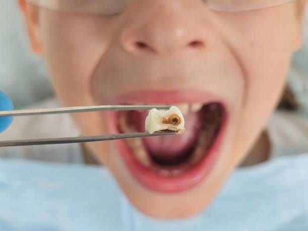 Best Emergency Tooth Extraction in Chatfield, MN